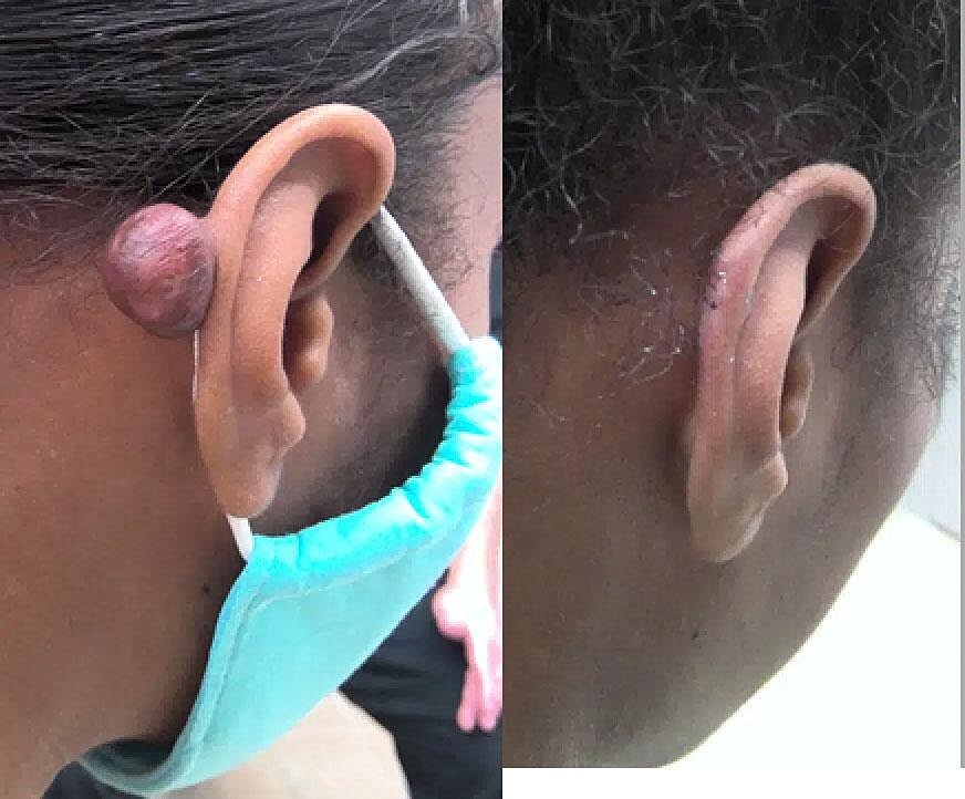 Keloid Removal Before & After Image
