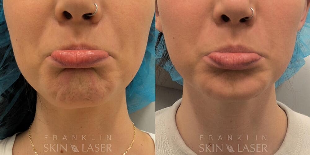 Neuromodulators Before & After