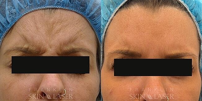 Neuromodulators Before & After