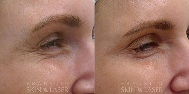 Neuromodulators Before & After