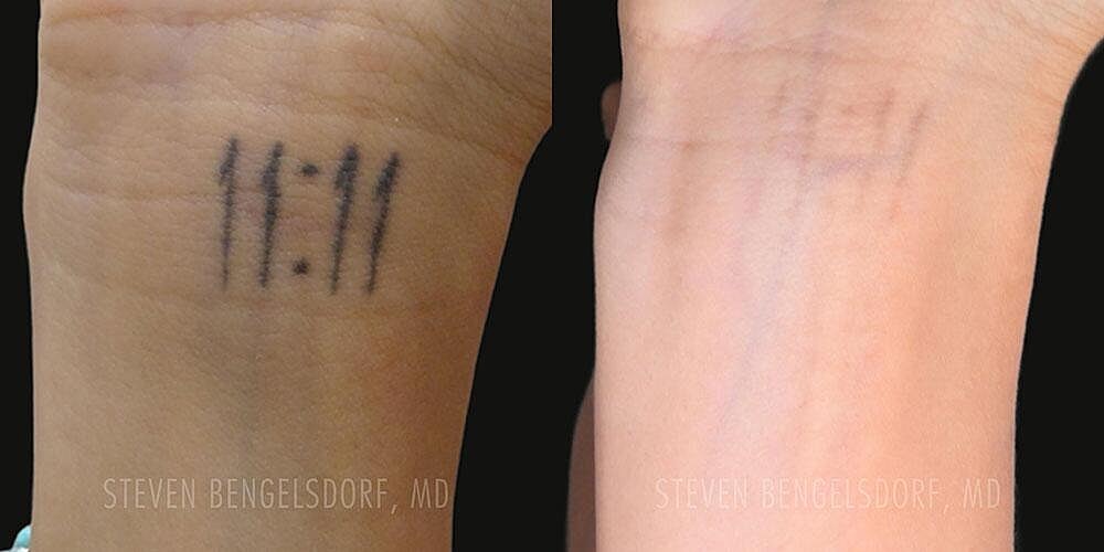 Tattoo Removal Before & After Image