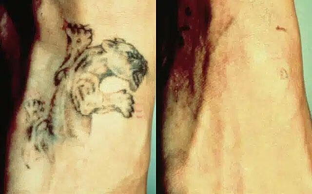 Tattoo Removal Before & After Image