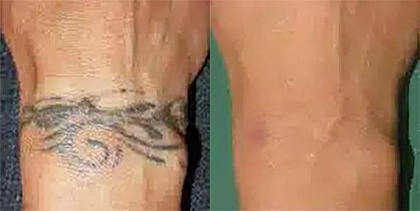 Tattoo Removal Before & After Image