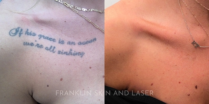 Tattoo Removal Before & After Image