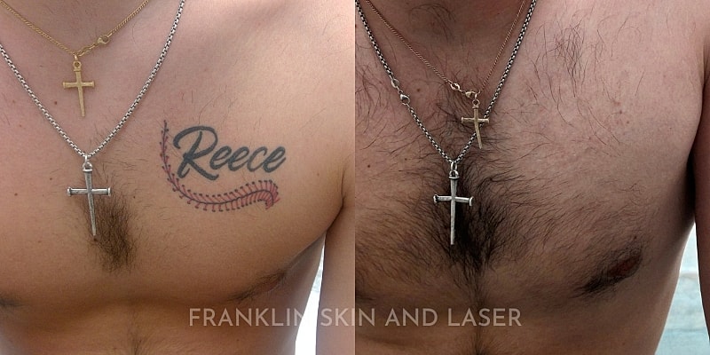 Tattoo Removal Before & After Image