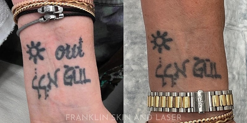 Tattoo Removal Gallery Before & After