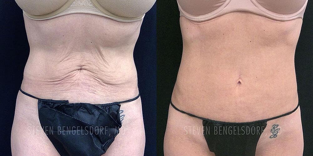 Morpheus8 Body Before & After Image