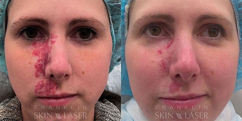 Birthmark Removal Before & After Image