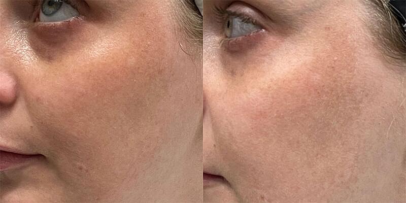 UltraClear Before & After Image
