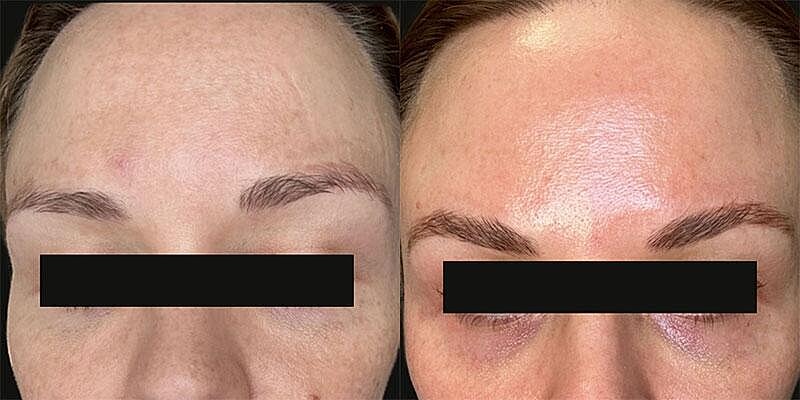UltraClear Before & After Image