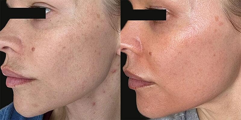 UltraClear Before & After Image