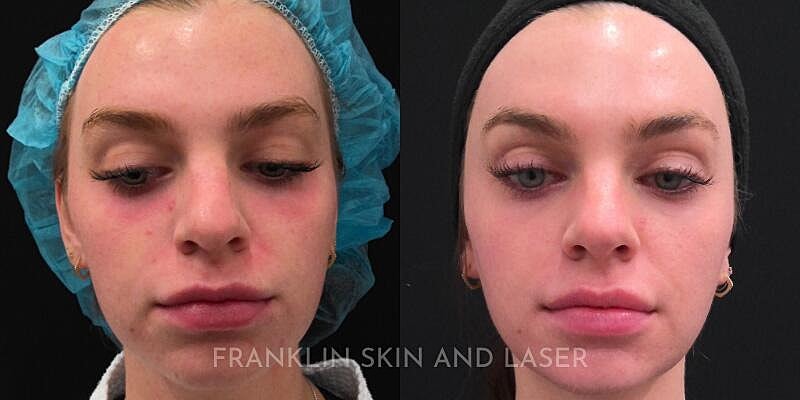 UltraClear Before & After Image