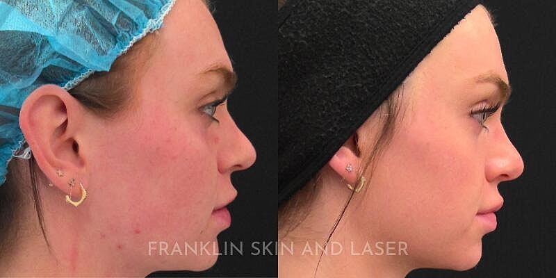 UltraClear Before & After Image