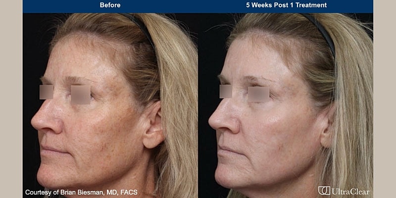 UltraClear Before & After Image