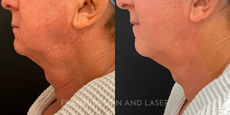 UltraClear Before & After Image