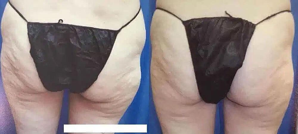 Cellulite Reduction Before & After Image
