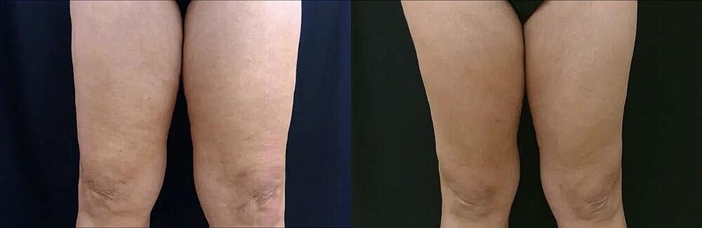 Cellulite Reduction Before & After Image