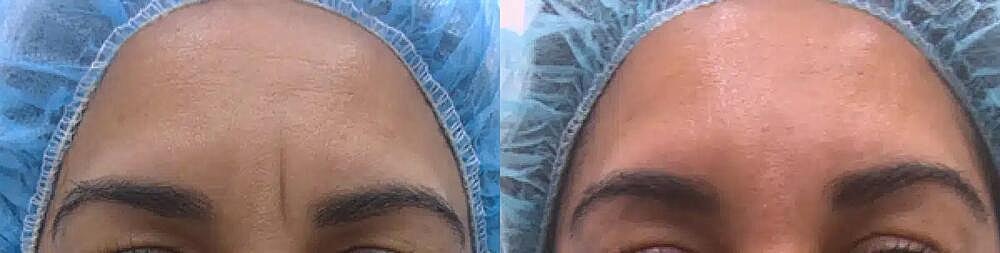 Upper Face Filler Before & After Image