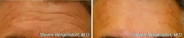 Upper Face Filler Before & After Image