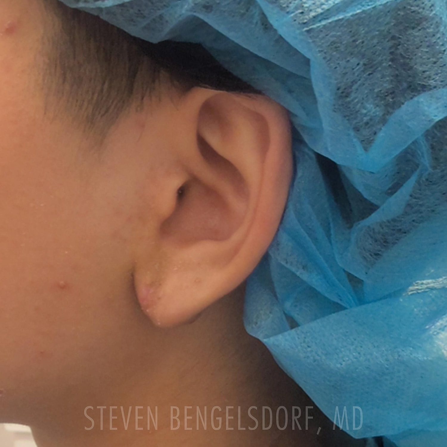 Keloid removal after