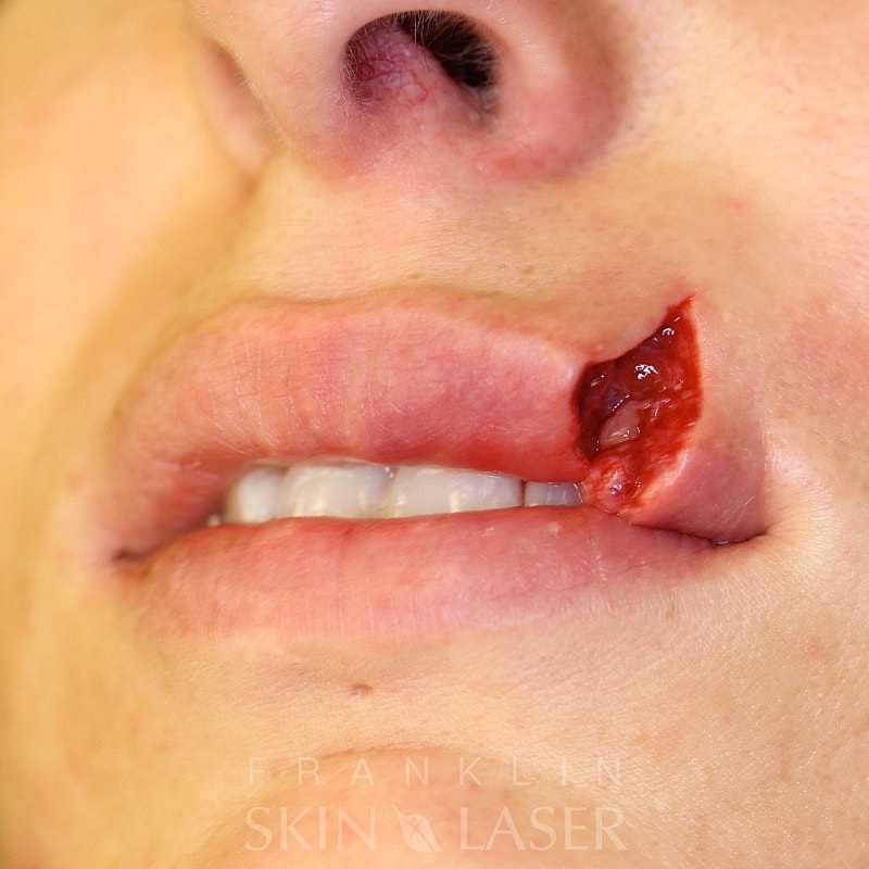 Keloid removal before