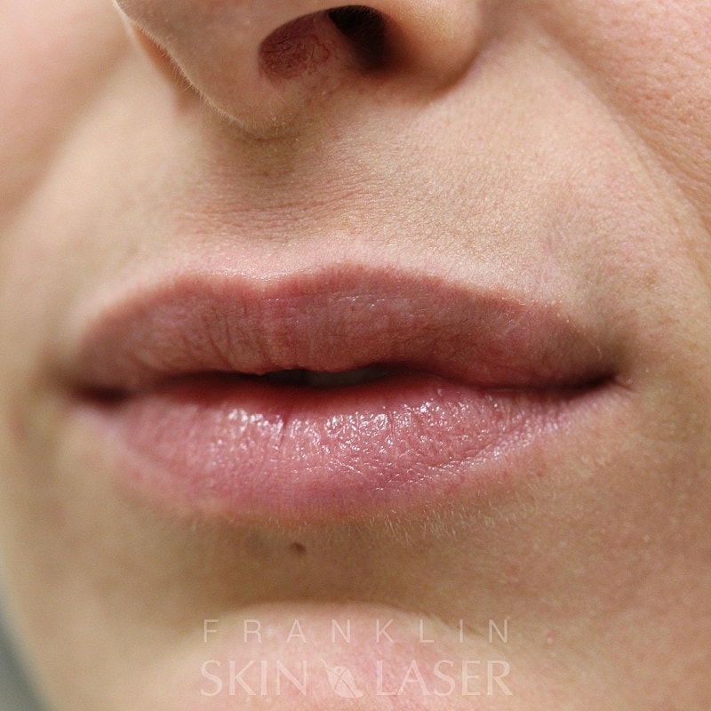 Keloid removal after