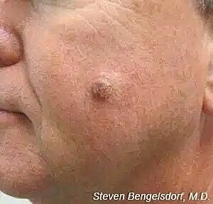 Mole removal before image