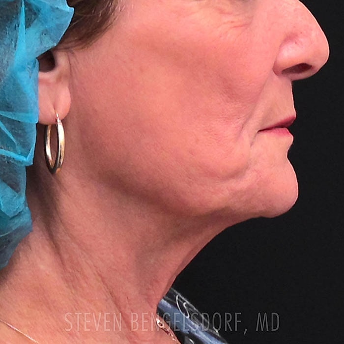 RF Sculpting Facial after image