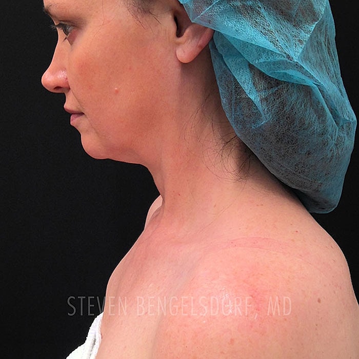 RF Sculpting Facial after image