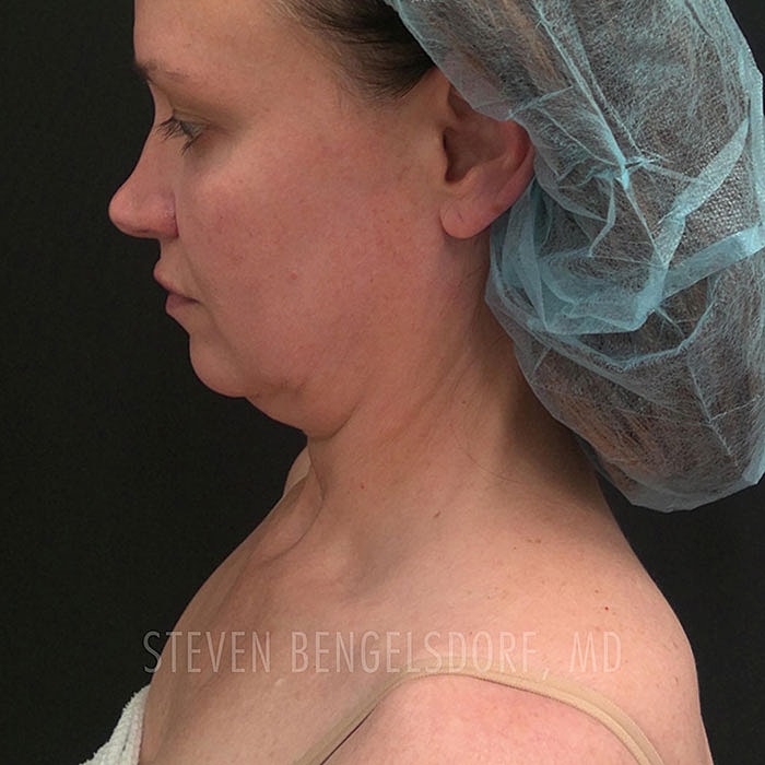 RF Sculpting Facial before image