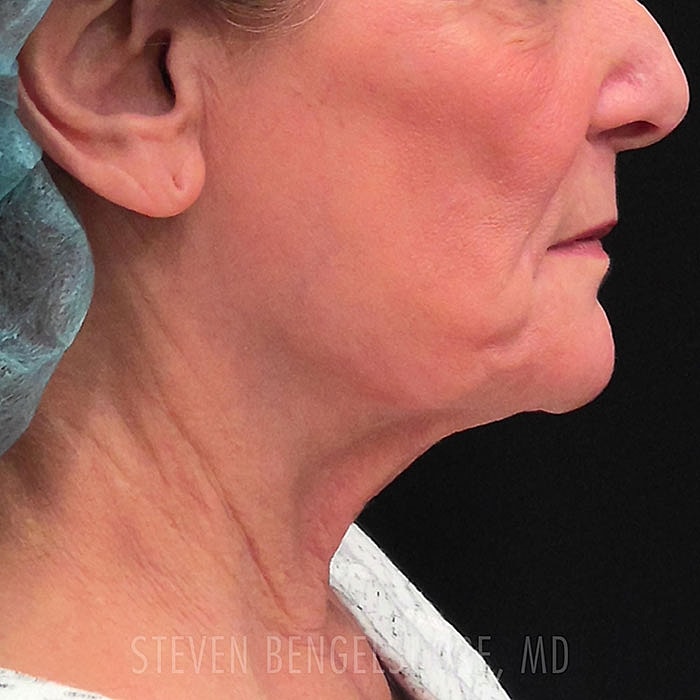 RF Sculpting Facial before image