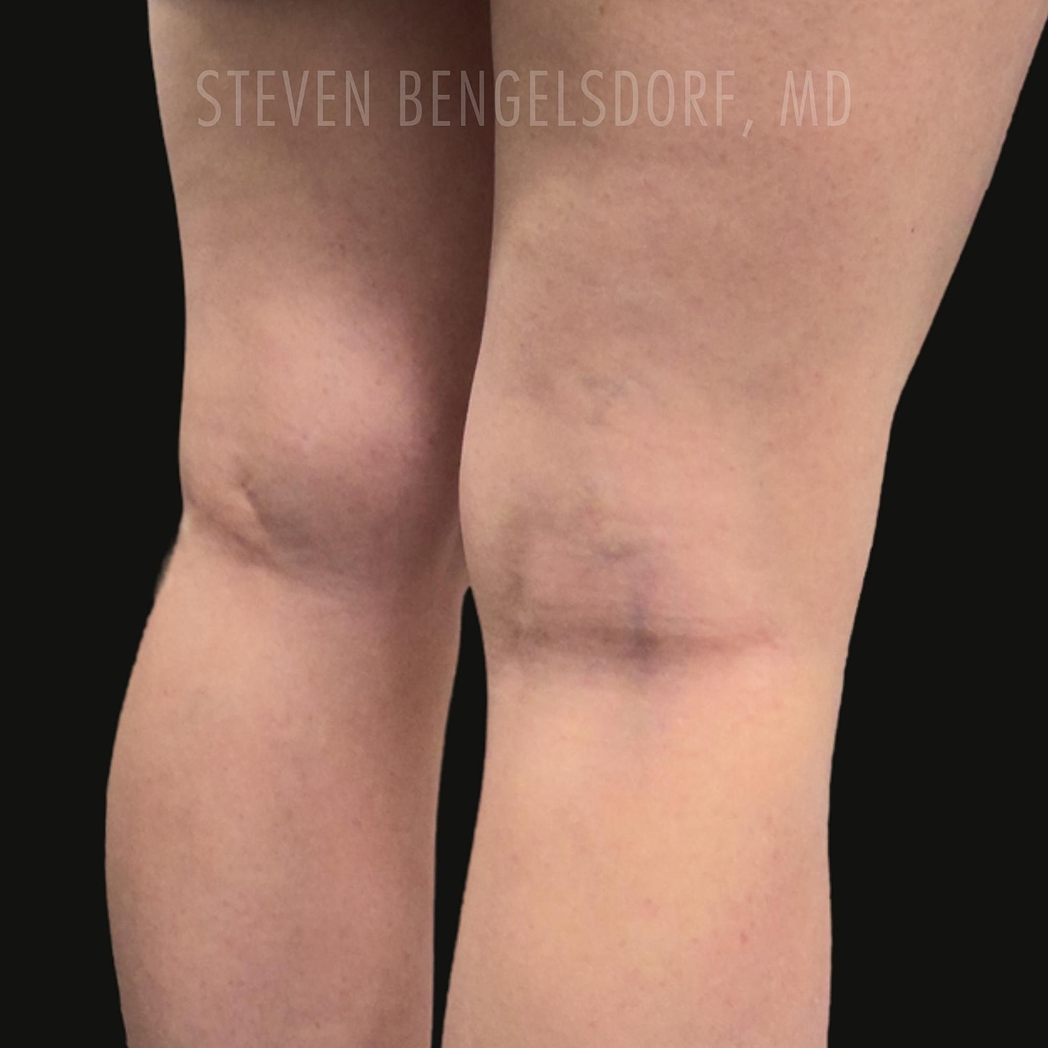 Sclerotherapy after image