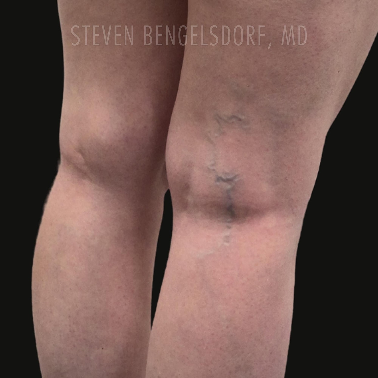 Sclerotherapy before image