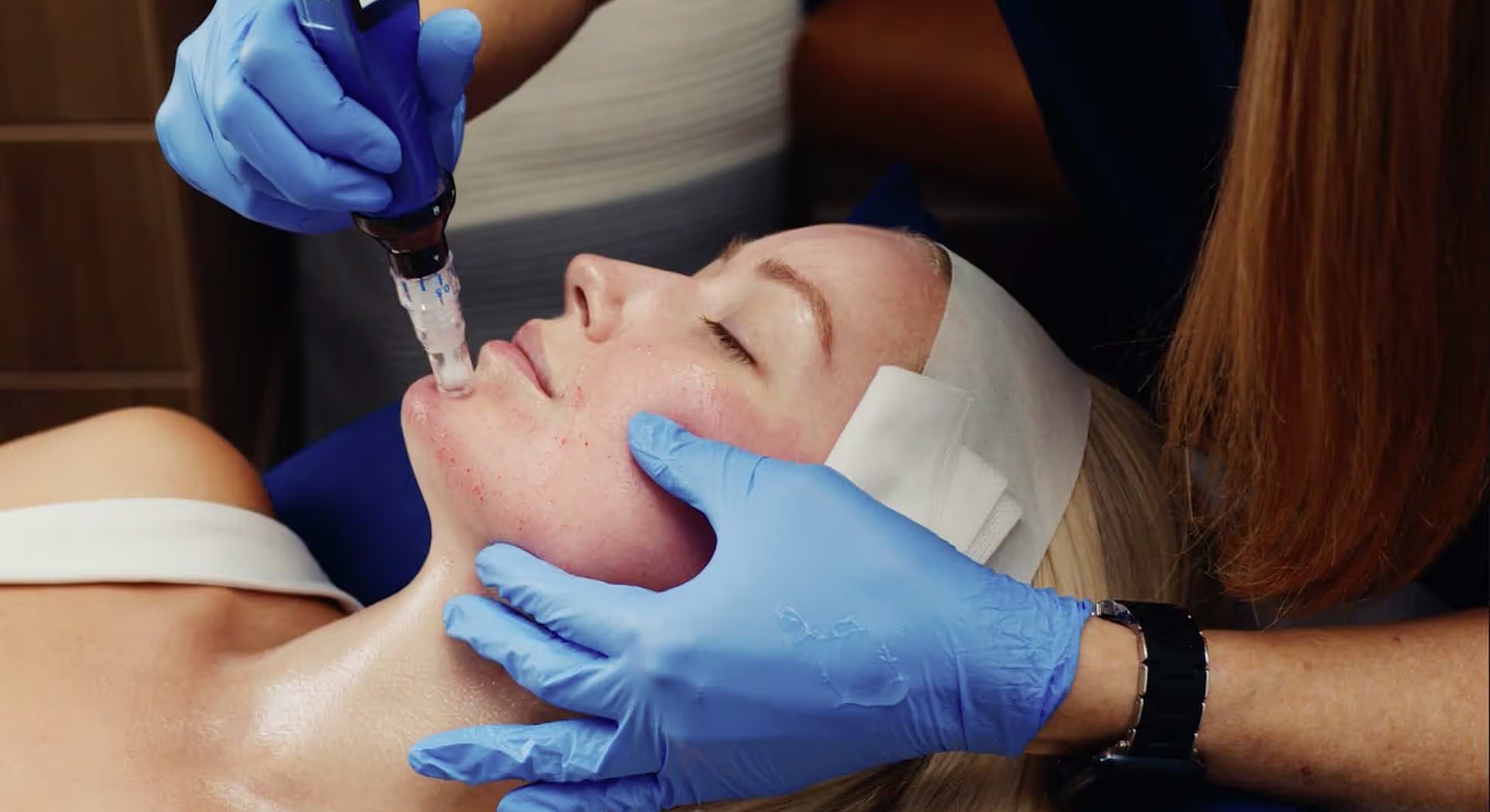 SkinPen Microneedling Franklin, TN