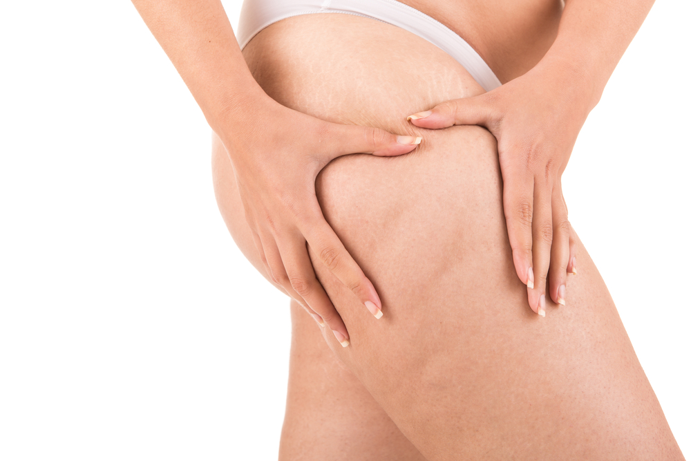 Laser Cellulite Treatment: What You Need to Know