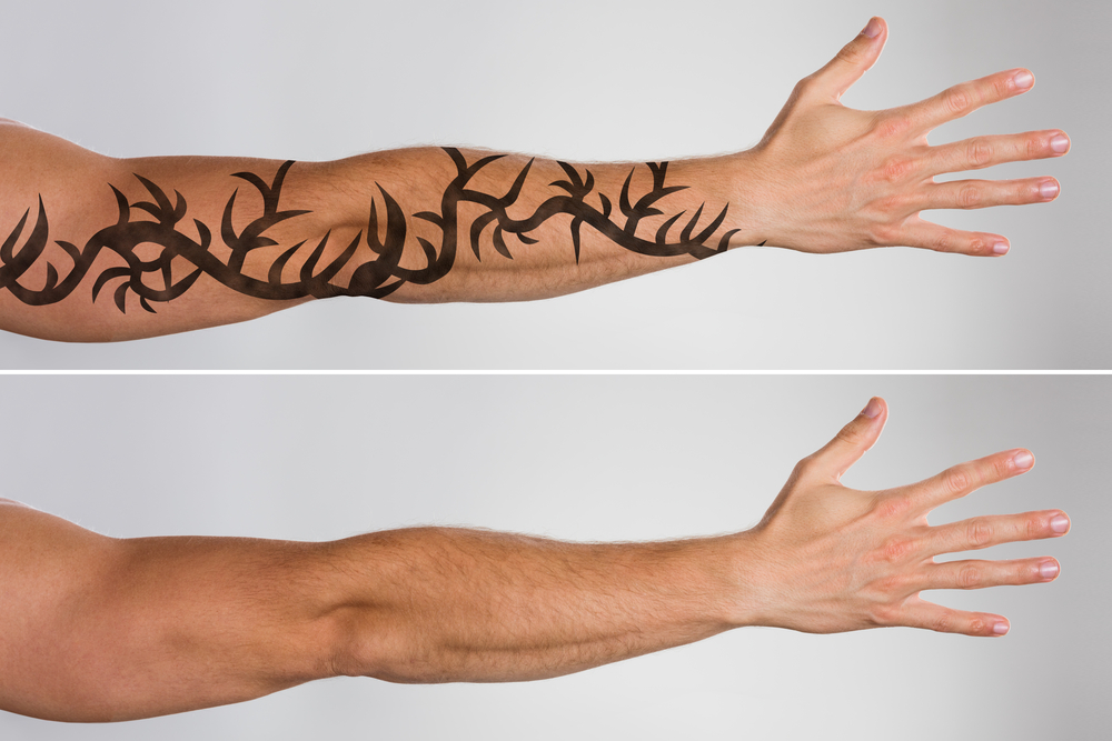 Before & After: Before & After Tattoo Removal | Zenith Cosmetic Clinics