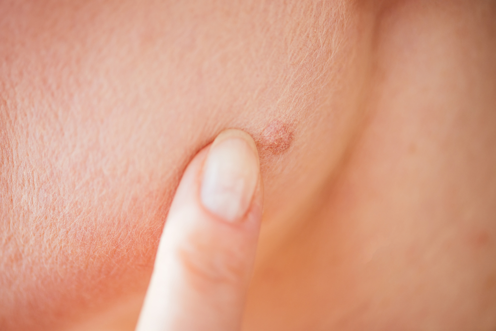 How do we remove moles?! If you have a mole on your face, seeing a