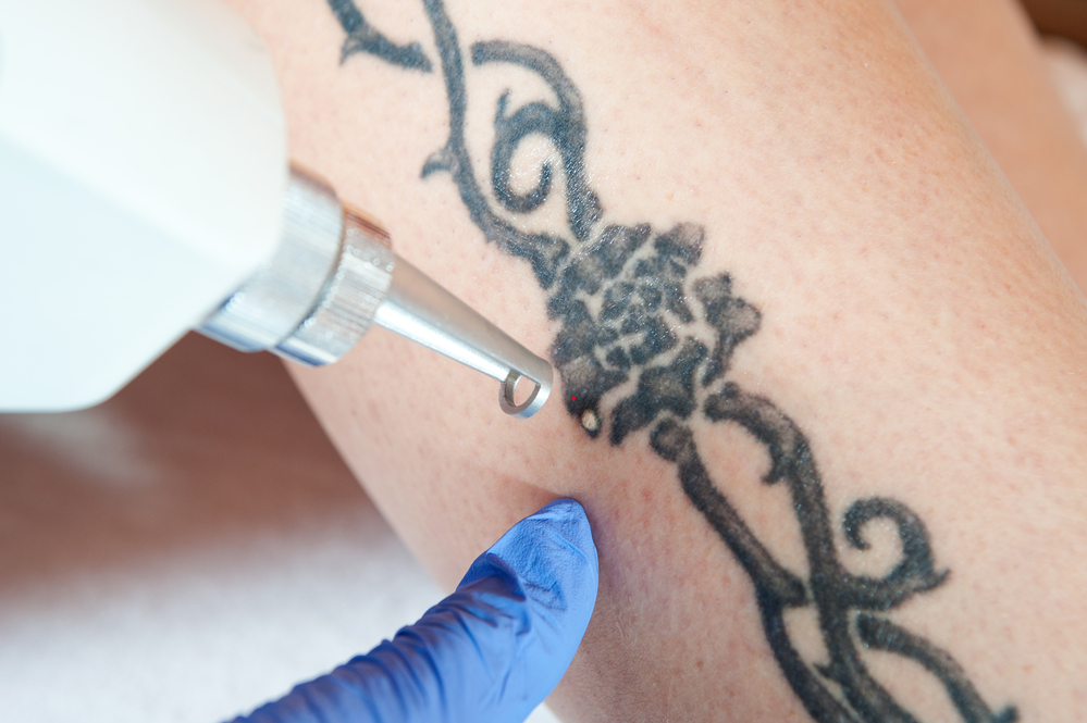 Starting Over: What You Should Know About Tattoo Removal: Holladay  Dermatology & Aesthetics: Dermatology and Aesthetic Specialists