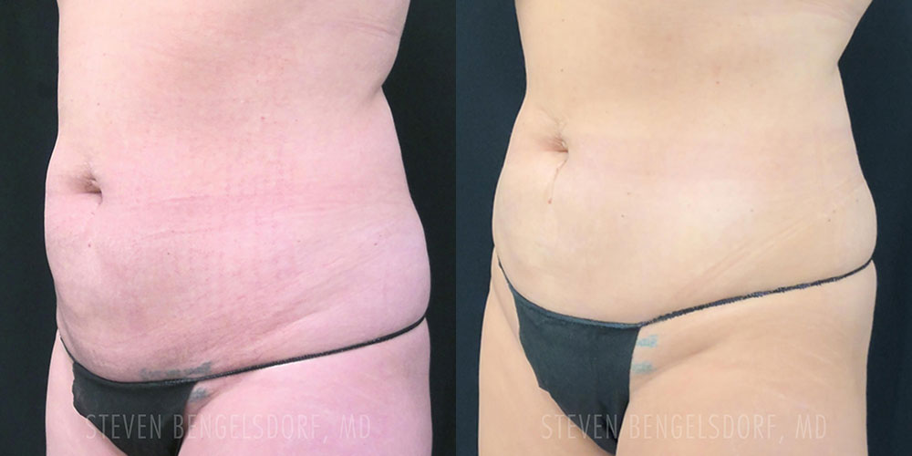 Emsculpt NEO Before & After Image