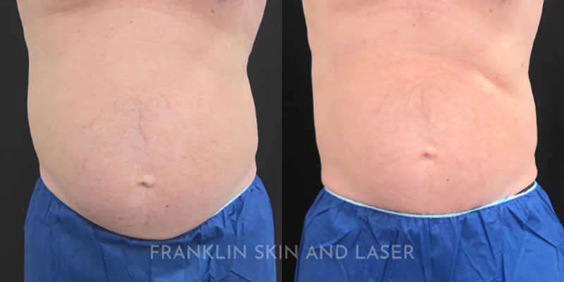 Emsculpt NEO Before & After Image