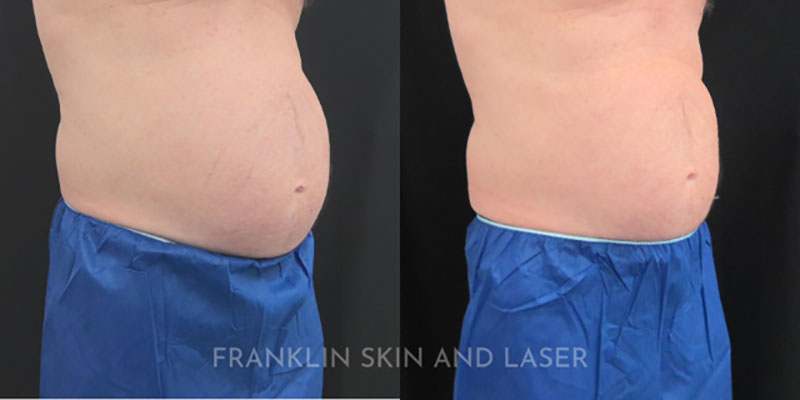 Emsculpt NEO Before & After Image