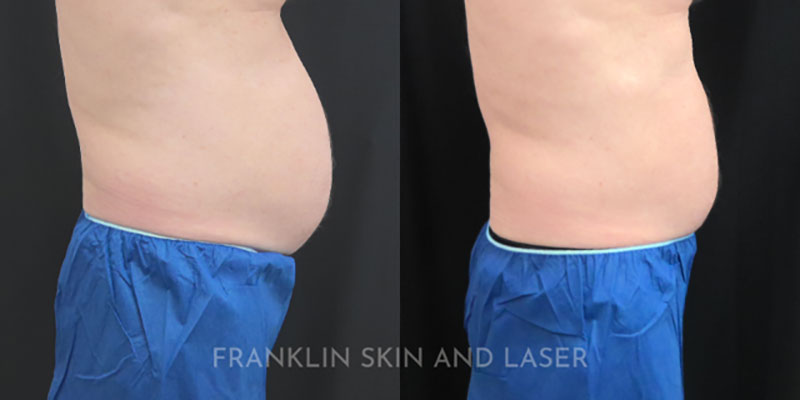 Emsculpt NEO Before & After Image