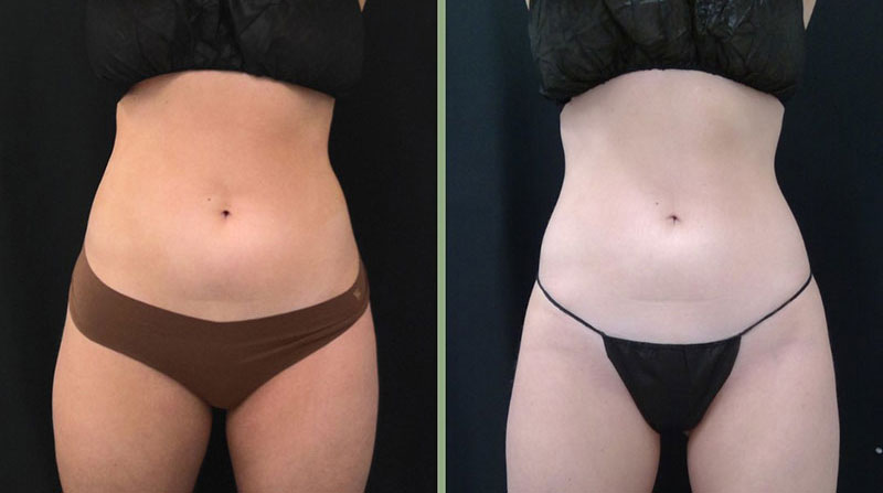 Weight Management Before & After Image