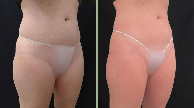 Weight Management Before & After Image
