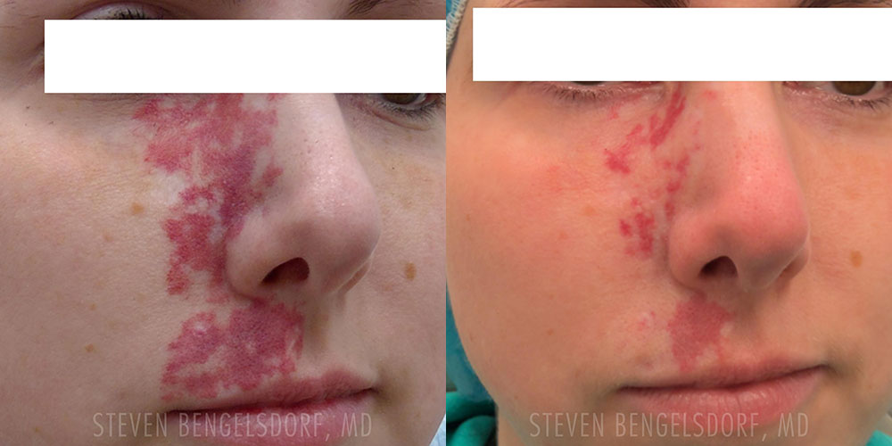 Birthmark Removal Before & After Image