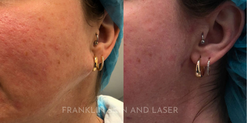 Cyst & Lipoma Removal Before & After Image