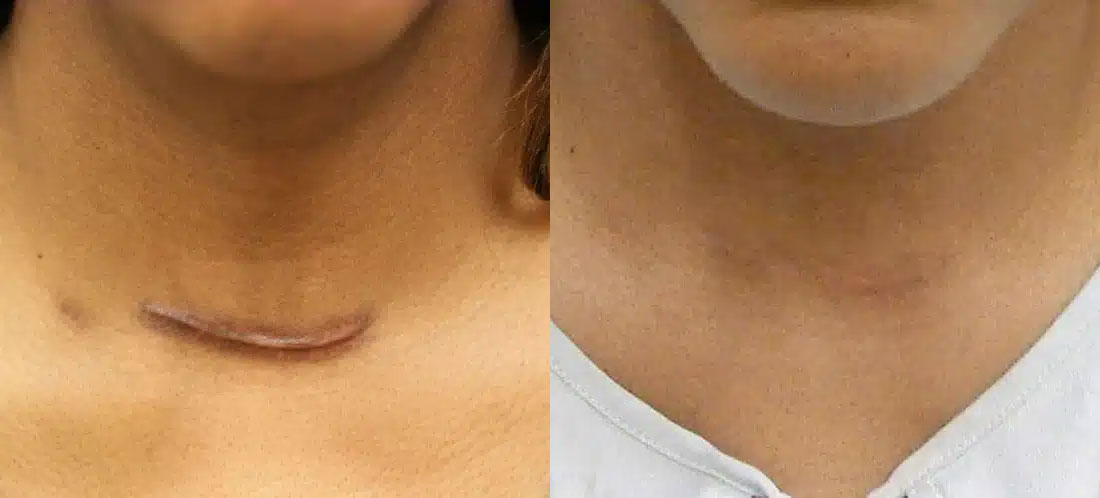 Keloid & Scar Revision Before & After Image
