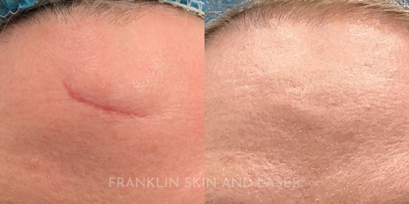 Keloid & Scar Revision Before & After Image