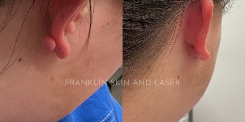 Keloid Removal Before & After Image