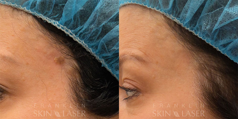 Mole Removal Before & After Image